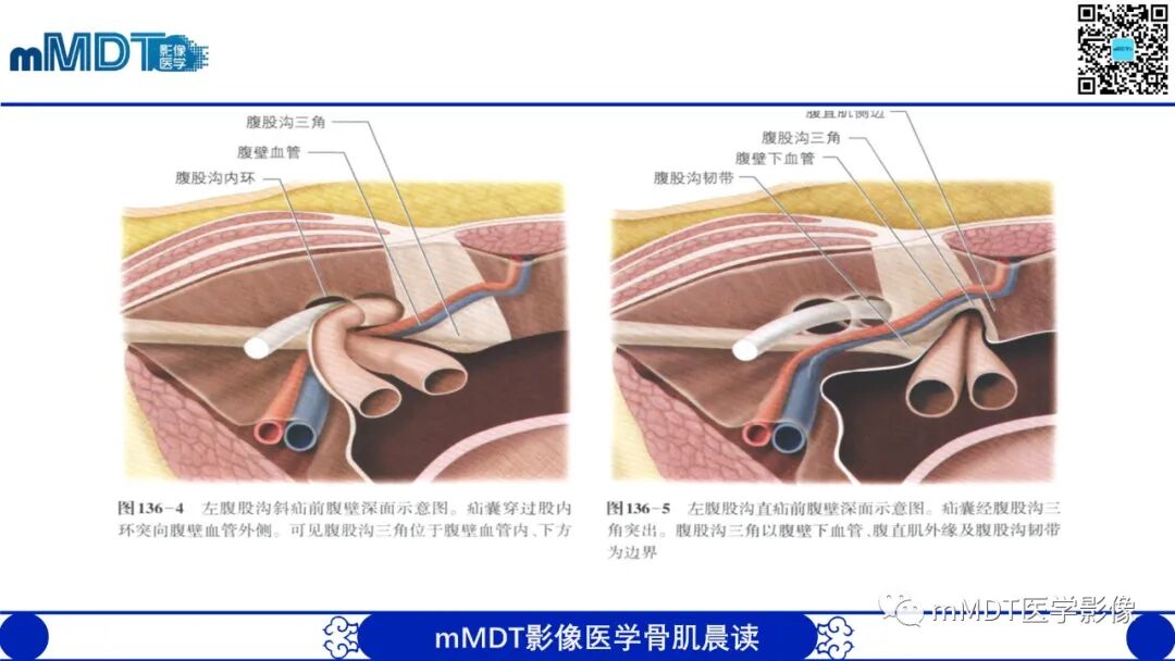 mmd在医学上什么意思常见腹外疝的影像诊断（修正版）_https://www.jmylbn.com_新闻资讯_第7张