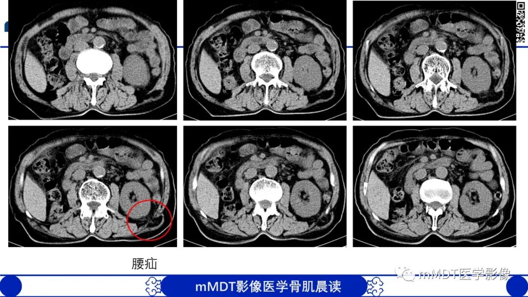 mmd在医学上什么意思常见腹外疝的影像诊断（修正版）_https://www.jmylbn.com_新闻资讯_第29张