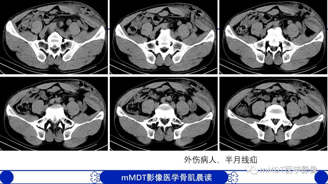 mmd在医学上什么意思常见腹外疝的影像诊断（修正版）_https://www.jmylbn.com_新闻资讯_第25张