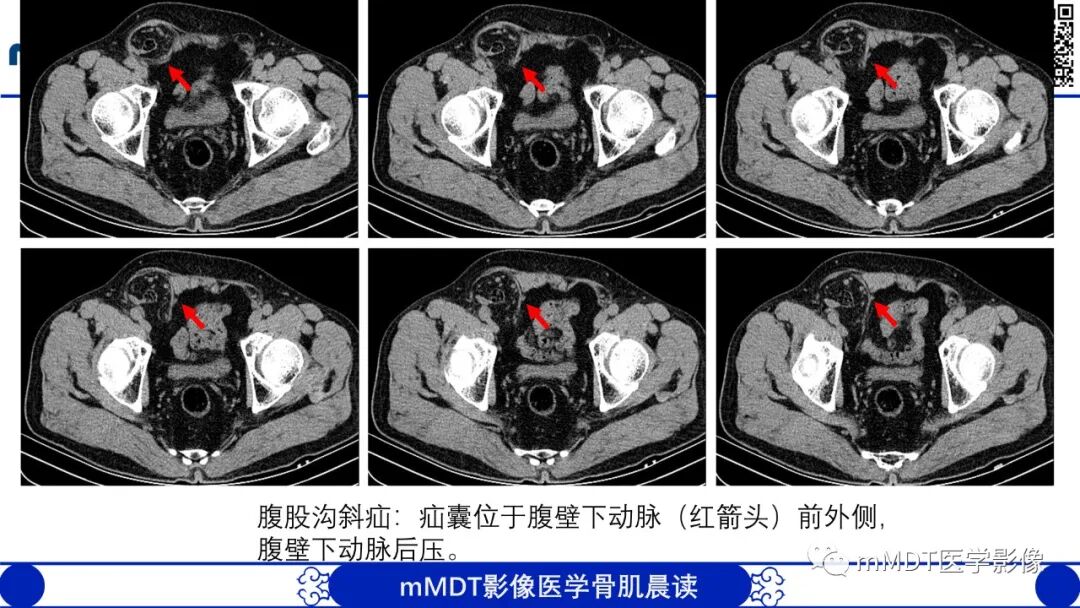 mmd在医学上什么意思常见腹外疝的影像诊断（修正版）_https://www.jmylbn.com_新闻资讯_第9张