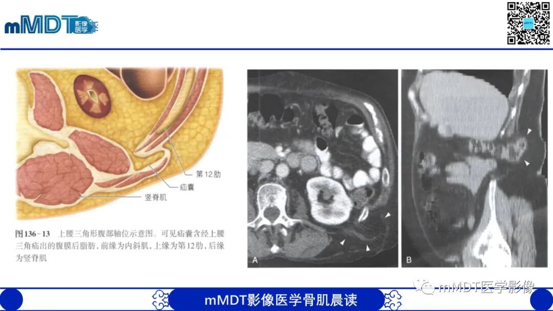 mmd在医学上什么意思常见腹外疝的影像诊断（修正版）_https://www.jmylbn.com_新闻资讯_第28张