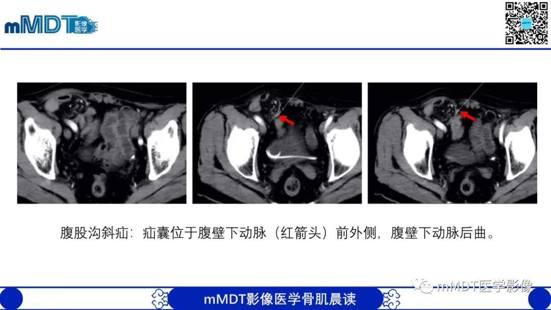 mmd在医学上什么意思常见腹外疝的影像诊断（修正版）_https://www.jmylbn.com_新闻资讯_第8张
