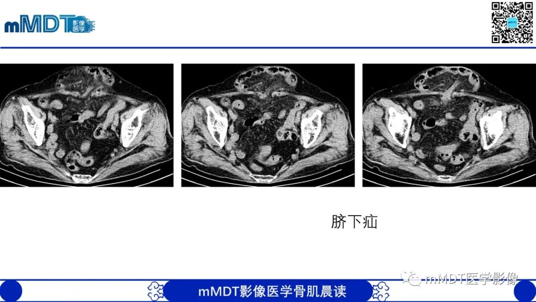 mmd在医学上什么意思常见腹外疝的影像诊断（修正版）_https://www.jmylbn.com_新闻资讯_第23张