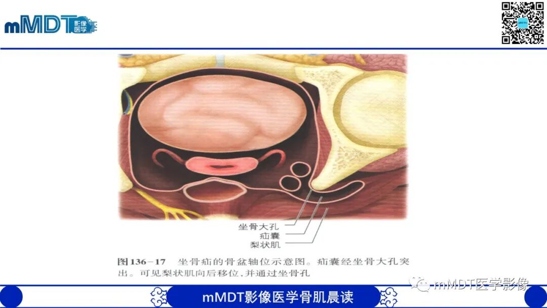 mmd在医学上什么意思常见腹外疝的影像诊断（修正版）_https://www.jmylbn.com_新闻资讯_第33张