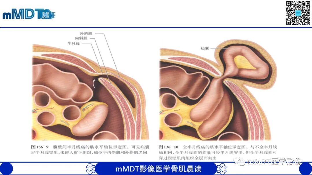 mmd在医学上什么意思常见腹外疝的影像诊断（修正版）_https://www.jmylbn.com_新闻资讯_第24张