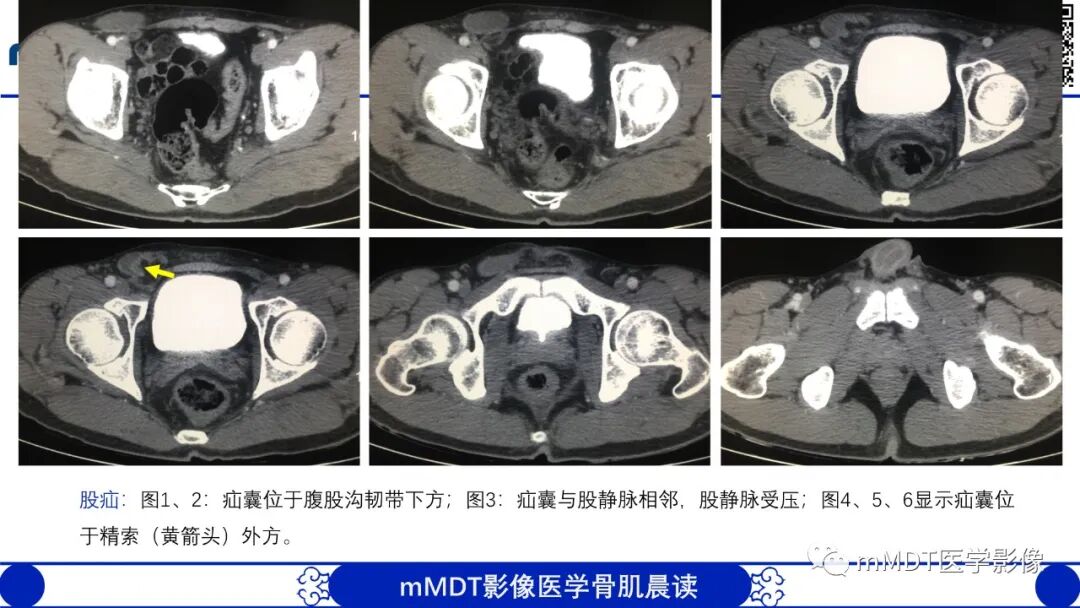 mmd在医学上什么意思常见腹外疝的影像诊断（修正版）_https://www.jmylbn.com_新闻资讯_第16张