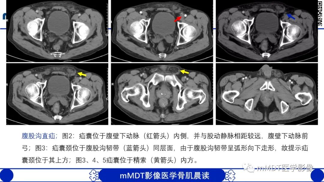mmd在医学上什么意思常见腹外疝的影像诊断（修正版）_https://www.jmylbn.com_新闻资讯_第12张