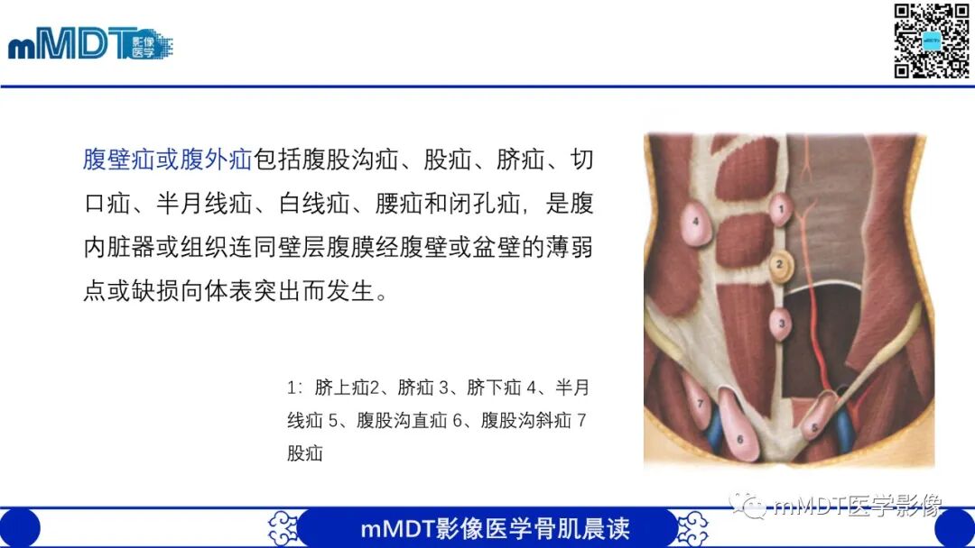 mmd在医学上什么意思常见腹外疝的影像诊断（修正版）_https://www.jmylbn.com_新闻资讯_第3张