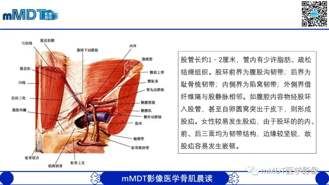 mmd在医学上什么意思常见腹外疝的影像诊断（修正版）_https://www.jmylbn.com_新闻资讯_第14张