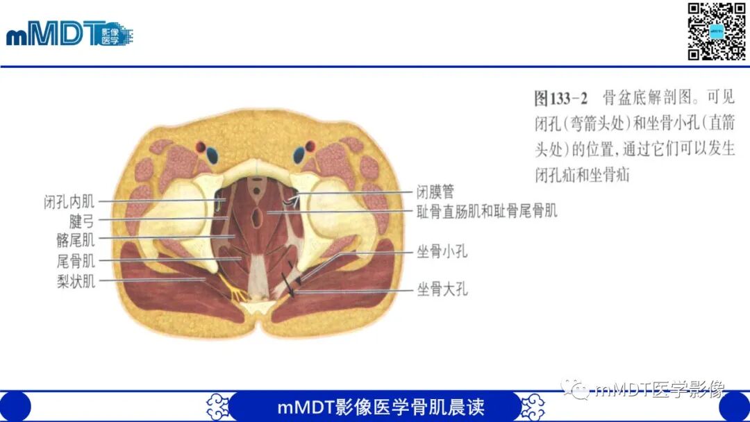 mmd在医学上什么意思常见腹外疝的影像诊断（修正版）_https://www.jmylbn.com_新闻资讯_第30张