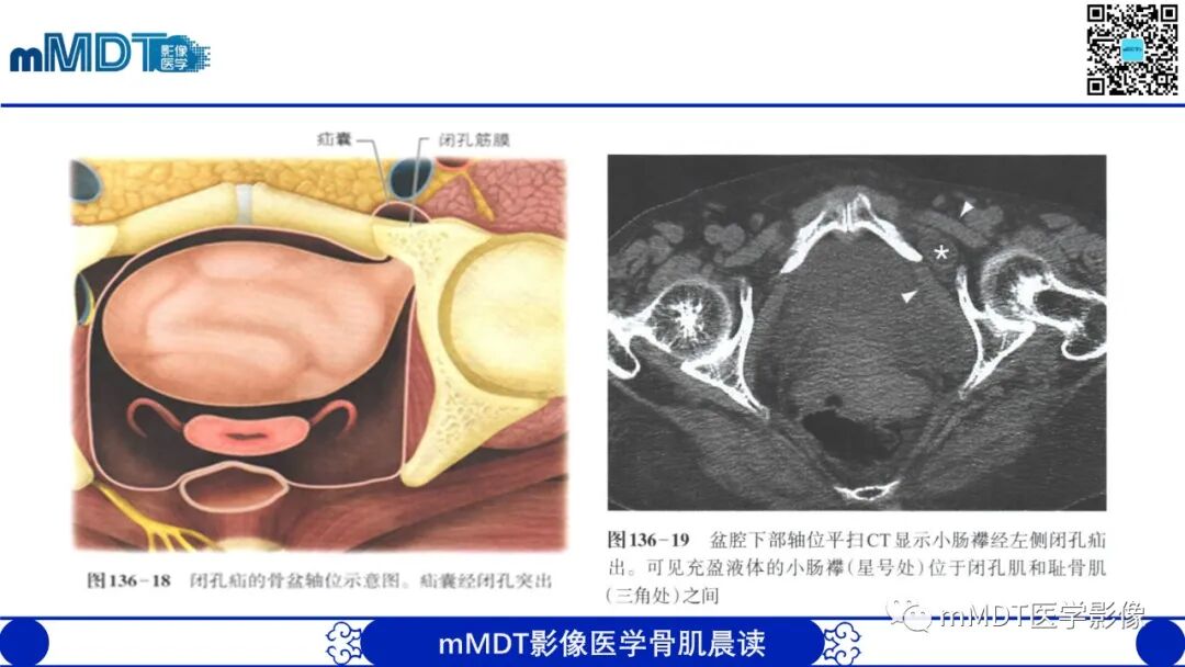 mmd在医学上什么意思常见腹外疝的影像诊断（修正版）_https://www.jmylbn.com_新闻资讯_第31张