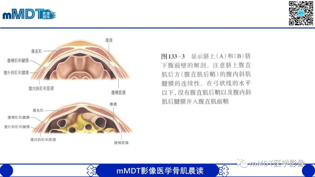 mmd在医学上什么意思常见腹外疝的影像诊断（修正版）_https://www.jmylbn.com_新闻资讯_第22张