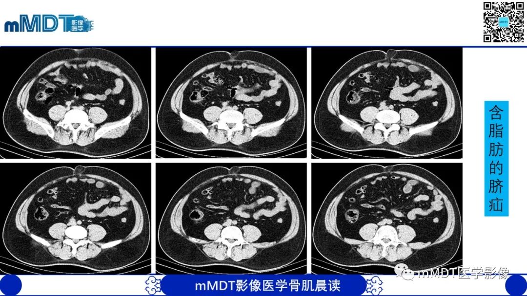 mmd在医学上什么意思常见腹外疝的影像诊断（修正版）_https://www.jmylbn.com_新闻资讯_第20张