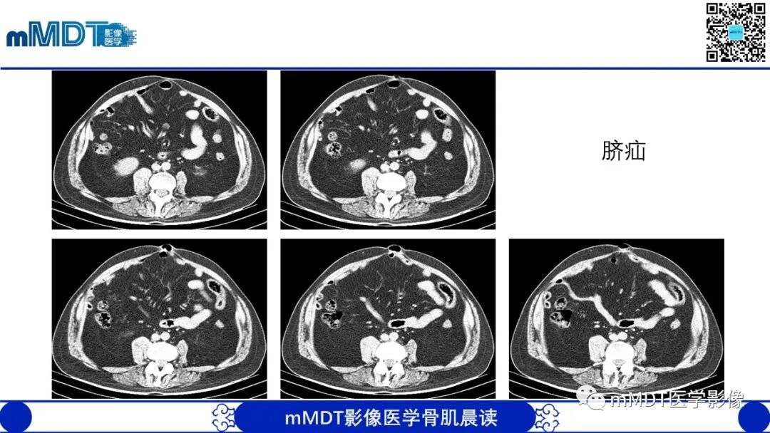 mmd在医学上什么意思常见腹外疝的影像诊断（修正版）_https://www.jmylbn.com_新闻资讯_第21张