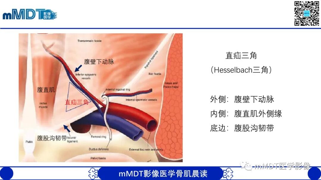 mmd在医学上什么意思常见腹外疝的影像诊断（修正版）_https://www.jmylbn.com_新闻资讯_第11张