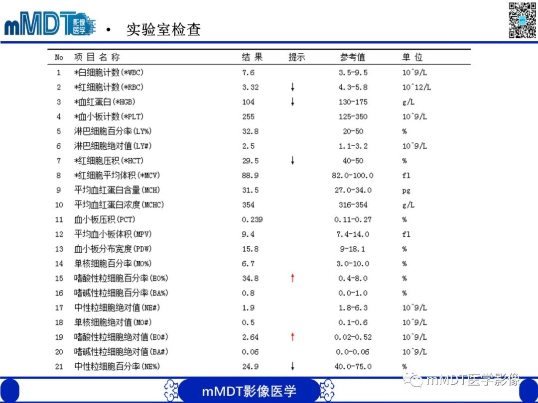 mmd在医学上什么意思嗜酸粒细胞增多综合征_https://www.jmylbn.com_新闻资讯_第5张