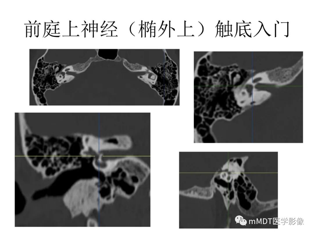 mmd在医学上什么意思触底四神共一门——穿行在内耳道的神经们_https://www.jmylbn.com_新闻资讯_第17张
