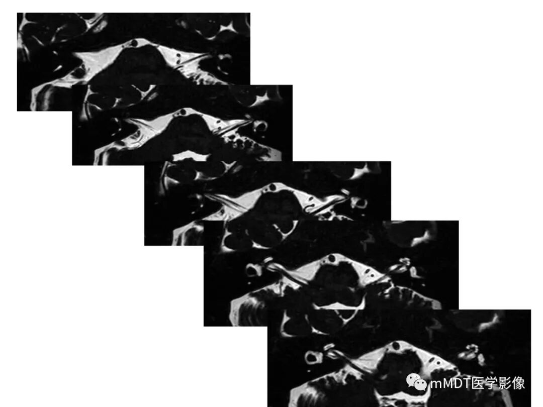 mmd在医学上什么意思触底四神共一门——穿行在内耳道的神经们_https://www.jmylbn.com_新闻资讯_第41张