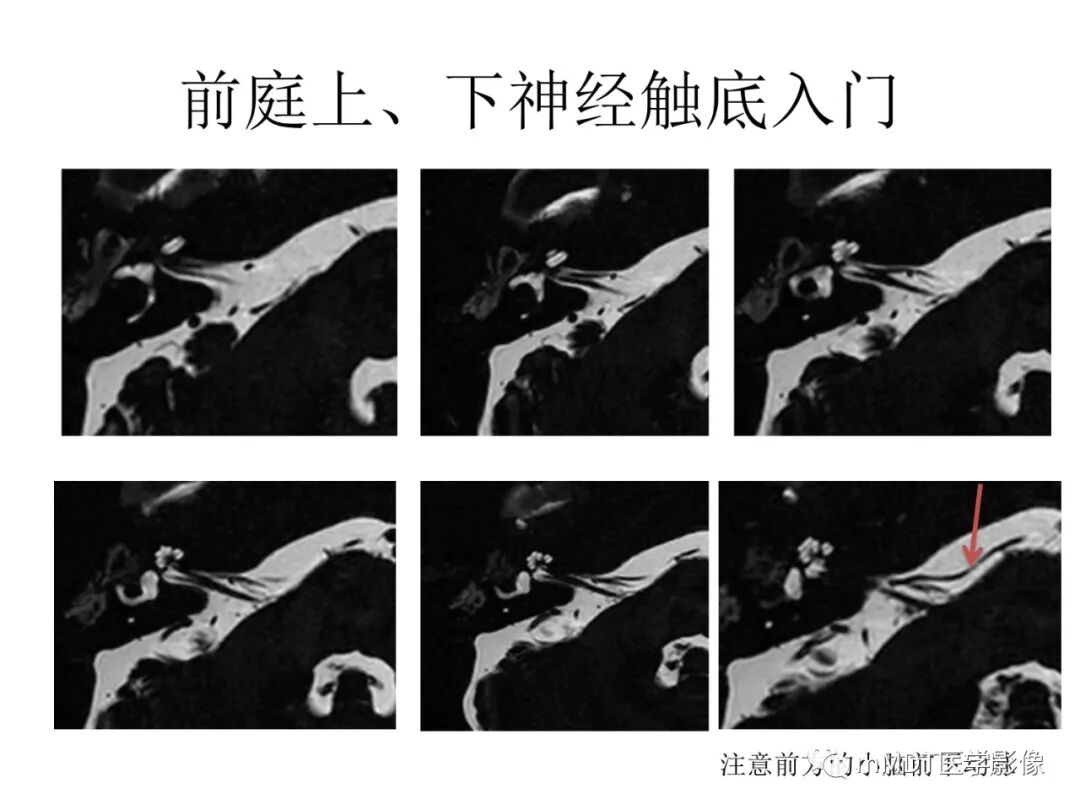 mmd在医学上什么意思触底四神共一门——穿行在内耳道的神经们_https://www.jmylbn.com_新闻资讯_第19张