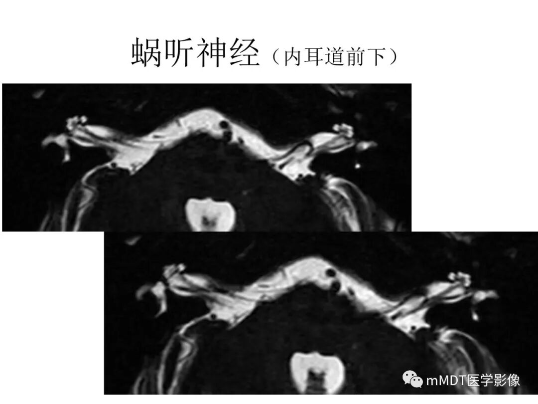 mmd在医学上什么意思触底四神共一门——穿行在内耳道的神经们_https://www.jmylbn.com_新闻资讯_第14张