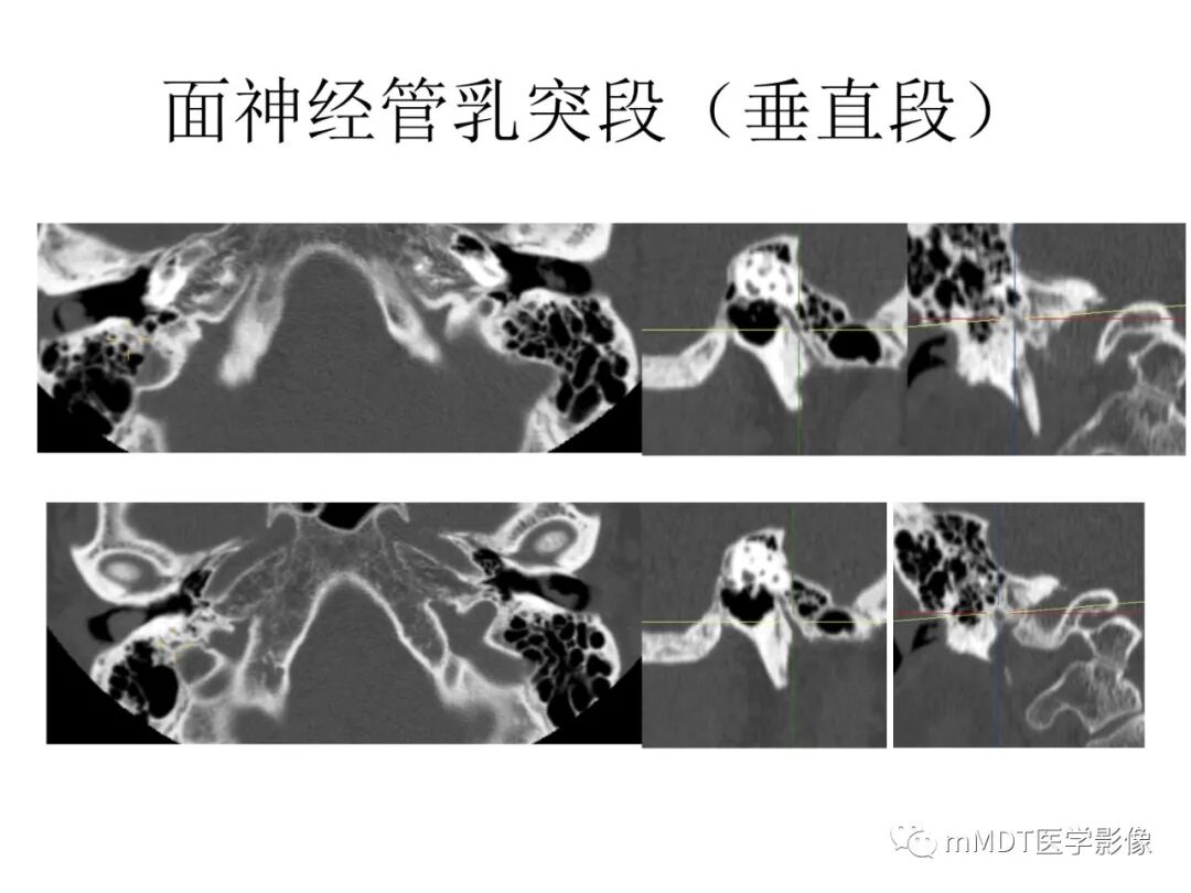 mmd在医学上什么意思触底四神共一门——穿行在内耳道的神经们_https://www.jmylbn.com_新闻资讯_第56张