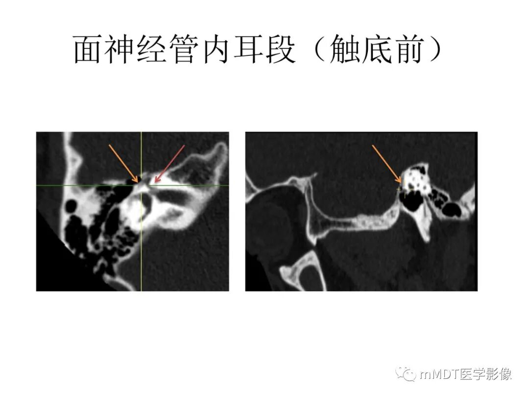 mmd在医学上什么意思触底四神共一门——穿行在内耳道的神经们_https://www.jmylbn.com_新闻资讯_第49张