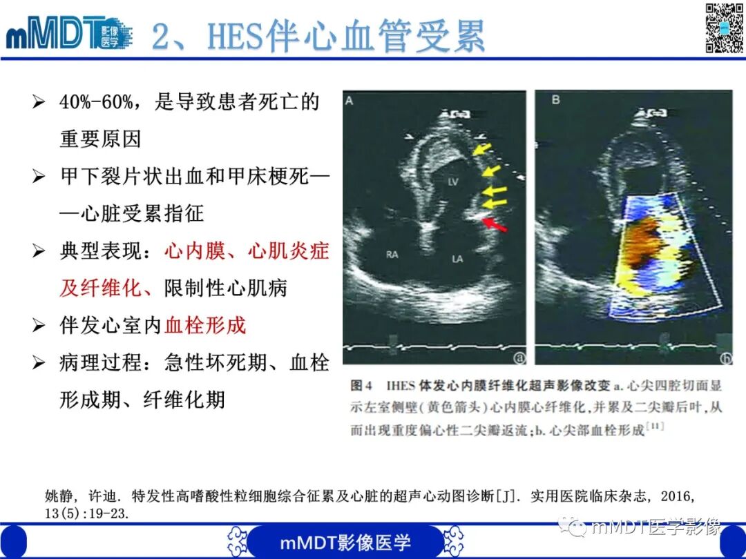 mmd在医学上什么意思嗜酸粒细胞增多综合征_https://www.jmylbn.com_新闻资讯_第18张