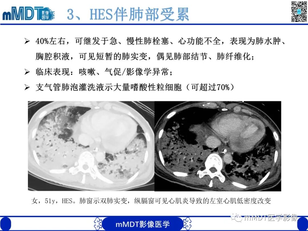 mmd在医学上什么意思嗜酸粒细胞增多综合征_https://www.jmylbn.com_新闻资讯_第20张