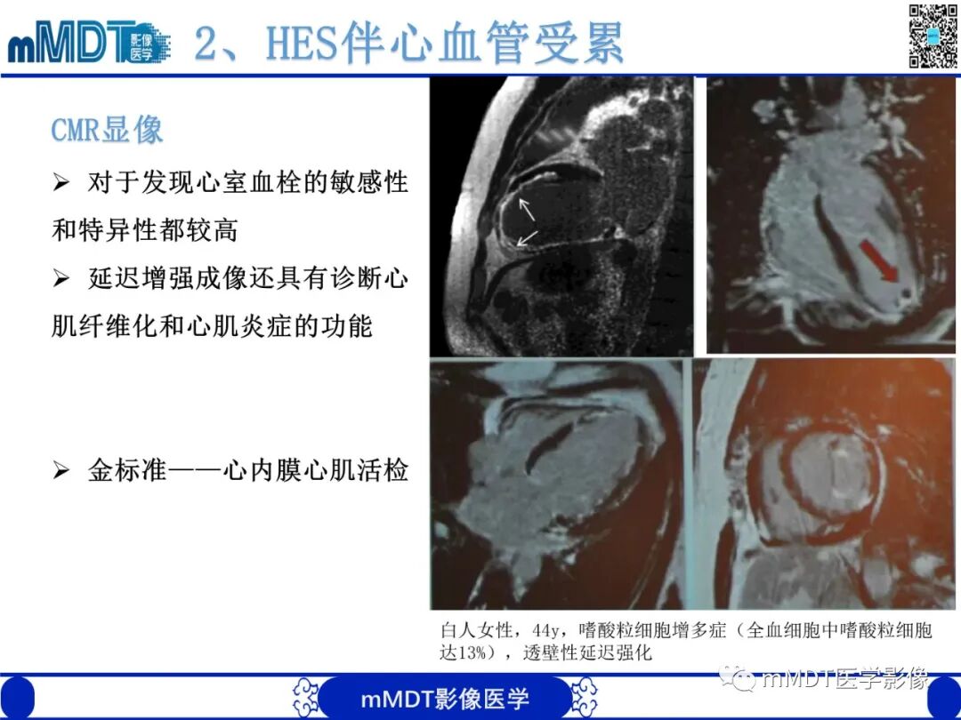 mmd在医学上什么意思嗜酸粒细胞增多综合征_https://www.jmylbn.com_新闻资讯_第19张