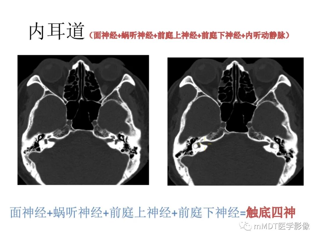 mmd在医学上什么意思触底四神共一门——穿行在内耳道的神经们_https://www.jmylbn.com_新闻资讯_第32张