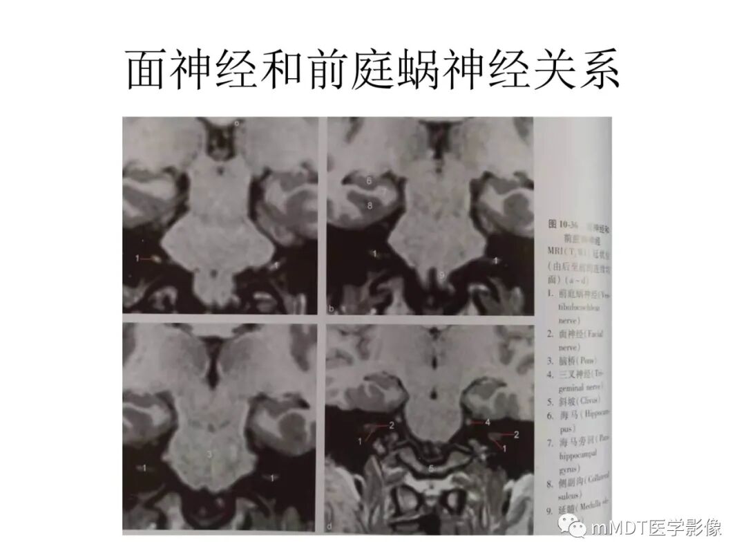 mmd在医学上什么意思触底四神共一门——穿行在内耳道的神经们_https://www.jmylbn.com_新闻资讯_第28张