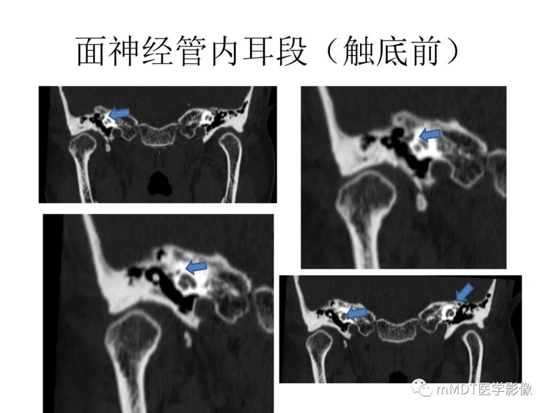 mmd在医学上什么意思触底四神共一门——穿行在内耳道的神经们_https://www.jmylbn.com_新闻资讯_第46张