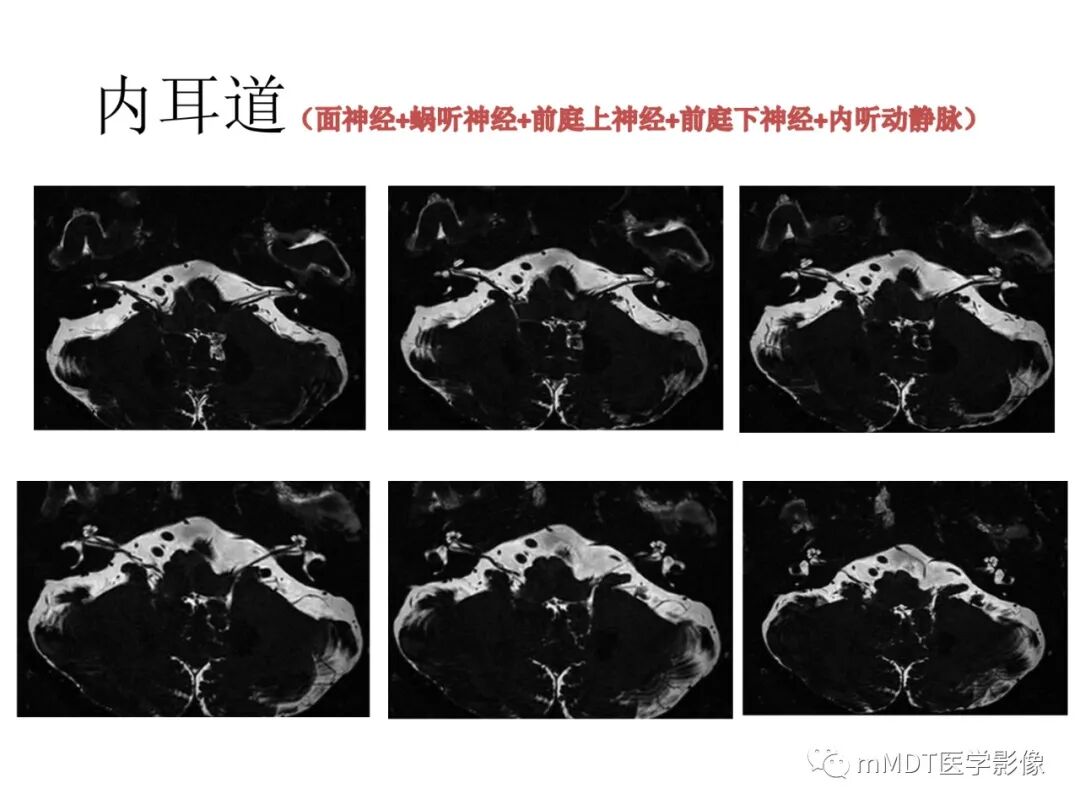 mmd在医学上什么意思触底四神共一门——穿行在内耳道的神经们_https://www.jmylbn.com_新闻资讯_第35张