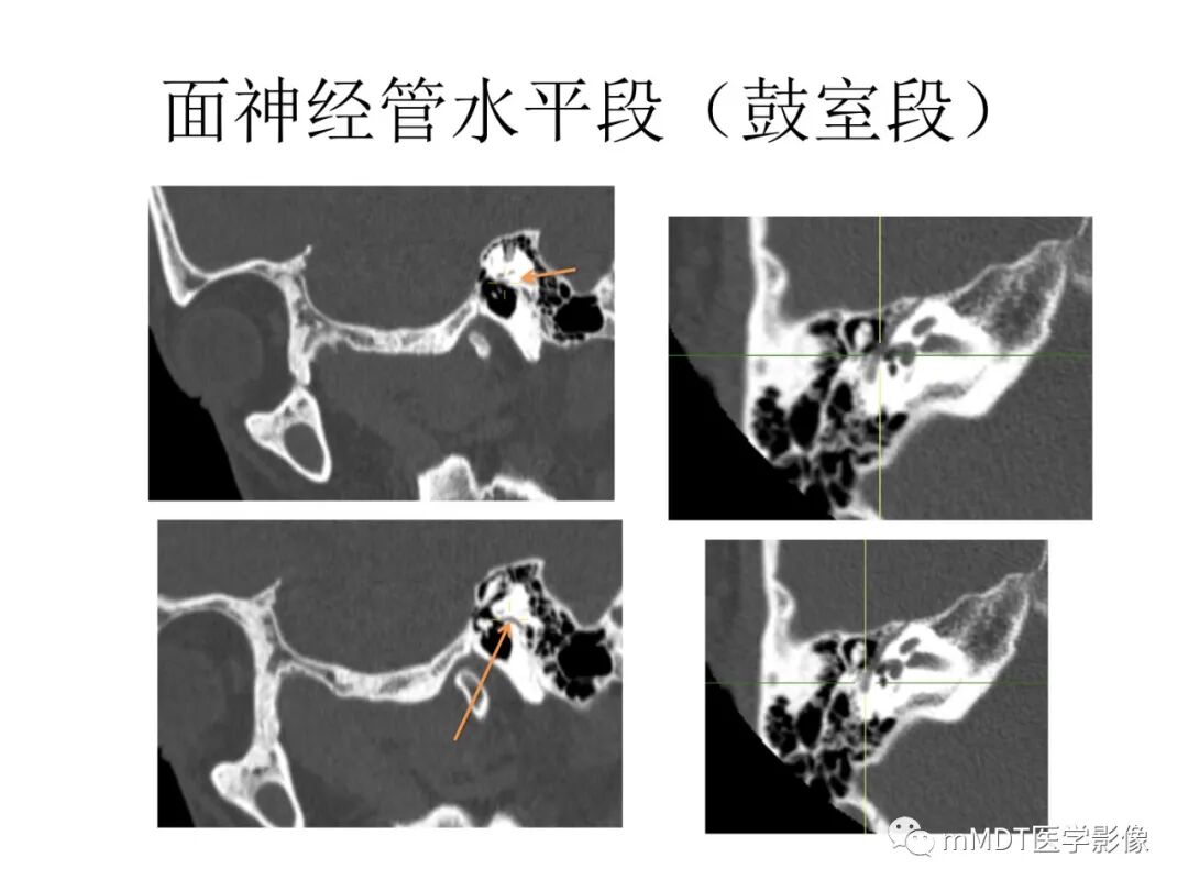 mmd在医学上什么意思触底四神共一门——穿行在内耳道的神经们_https://www.jmylbn.com_新闻资讯_第54张