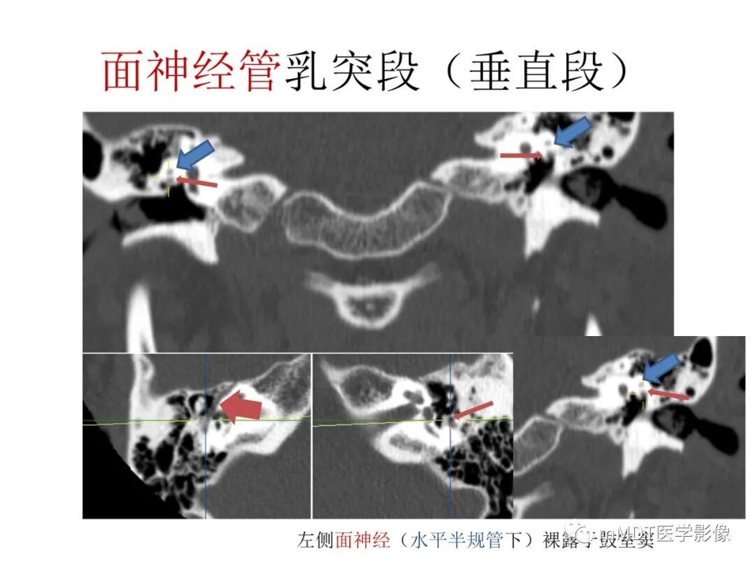 mmd在医学上什么意思触底四神共一门——穿行在内耳道的神经们_https://www.jmylbn.com_新闻资讯_第57张