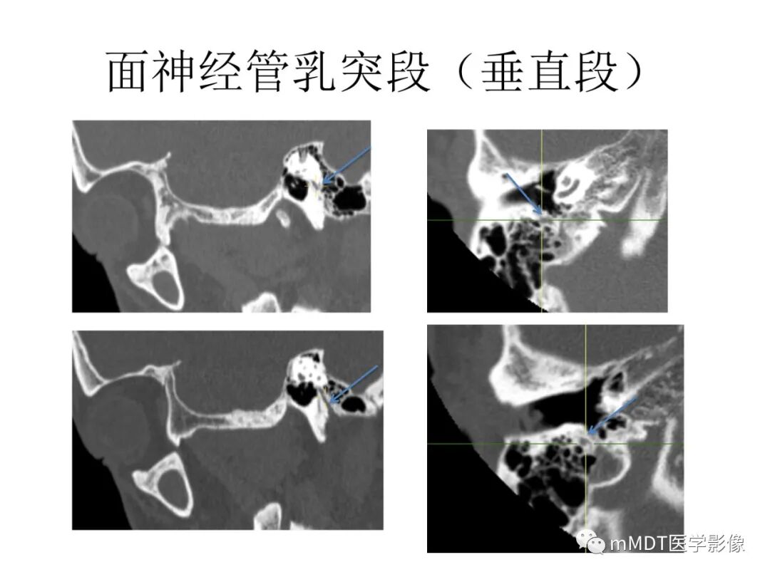 mmd在医学上什么意思触底四神共一门——穿行在内耳道的神经们_https://www.jmylbn.com_新闻资讯_第61张