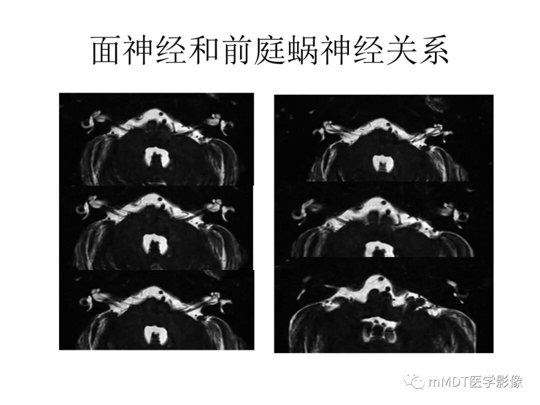mmd在医学上什么意思触底四神共一门——穿行在内耳道的神经们_https://www.jmylbn.com_新闻资讯_第27张