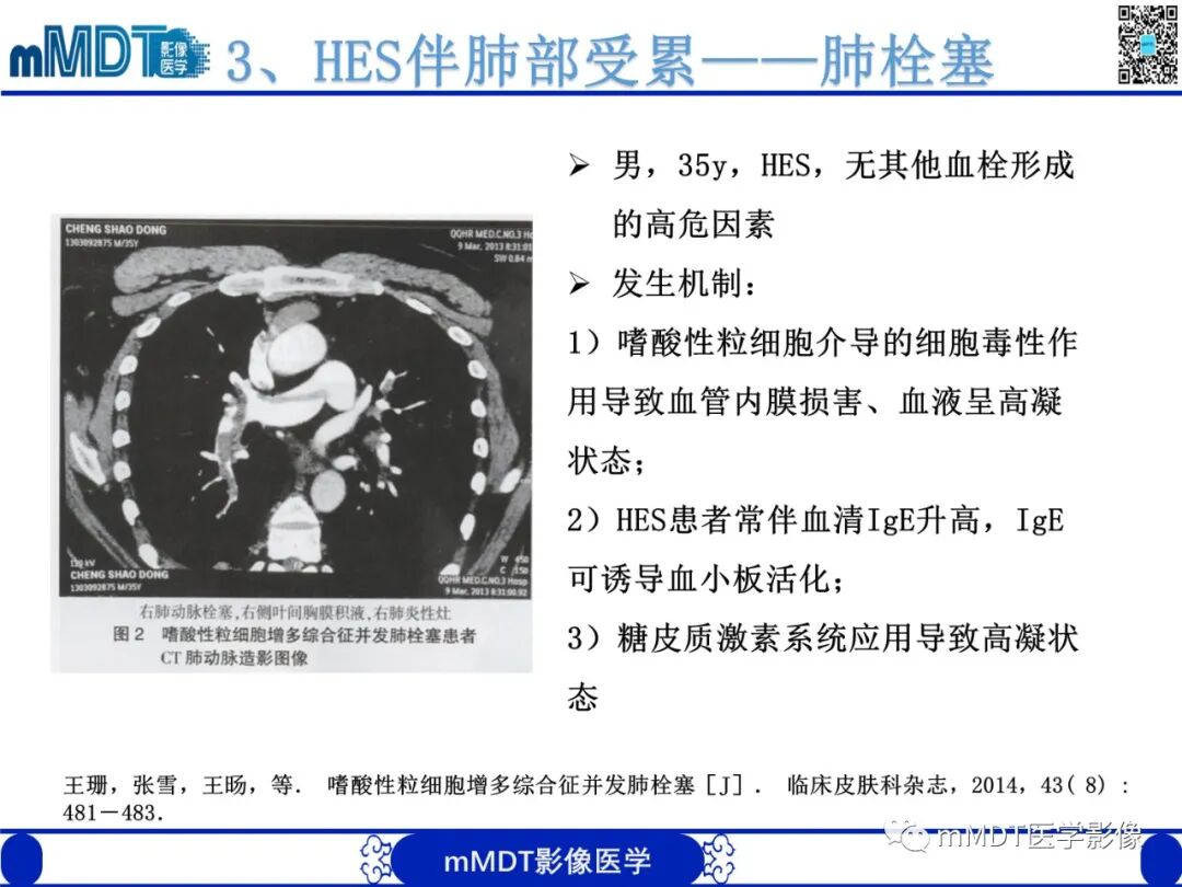 mmd在医学上什么意思嗜酸粒细胞增多综合征_https://www.jmylbn.com_新闻资讯_第21张