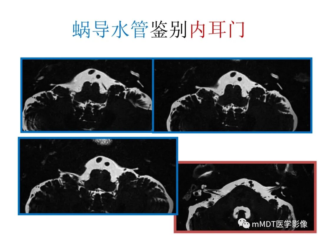 mmd在医学上什么意思触底四神共一门——穿行在内耳道的神经们_https://www.jmylbn.com_新闻资讯_第84张