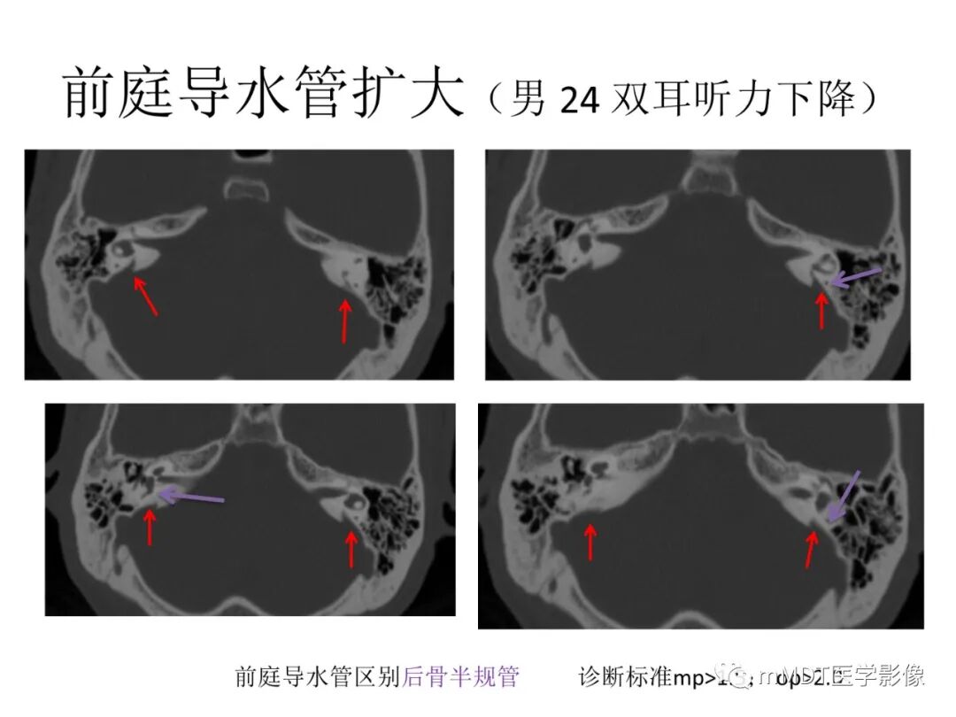 mmd在医学上什么意思触底四神共一门——穿行在内耳道的神经们_https://www.jmylbn.com_新闻资讯_第81张