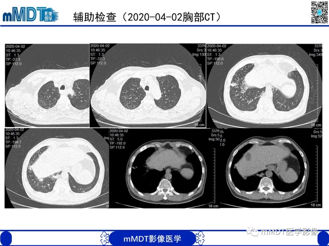 mmd在医学上什么意思嗜酸粒细胞增多综合征_https://www.jmylbn.com_新闻资讯_第10张