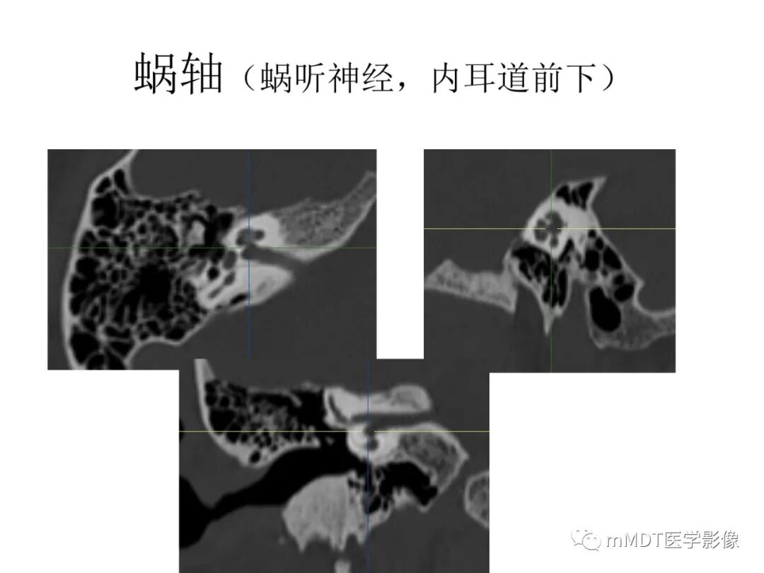 mmd在医学上什么意思触底四神共一门——穿行在内耳道的神经们_https://www.jmylbn.com_新闻资讯_第13张