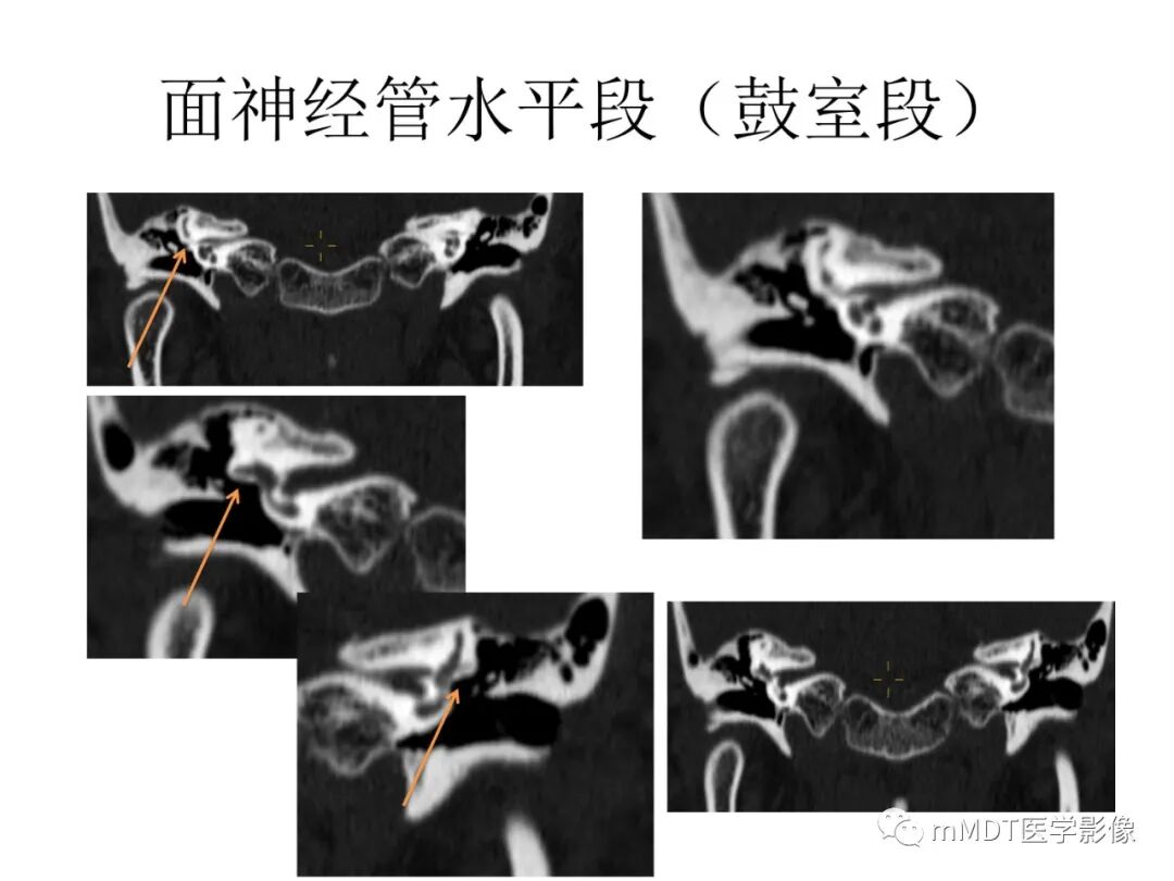 mmd在医学上什么意思触底四神共一门——穿行在内耳道的神经们_https://www.jmylbn.com_新闻资讯_第51张