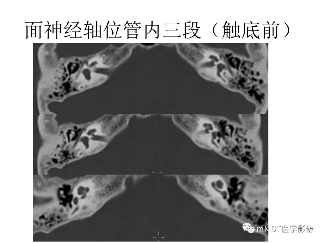 mmd在医学上什么意思触底四神共一门——穿行在内耳道的神经们_https://www.jmylbn.com_新闻资讯_第44张