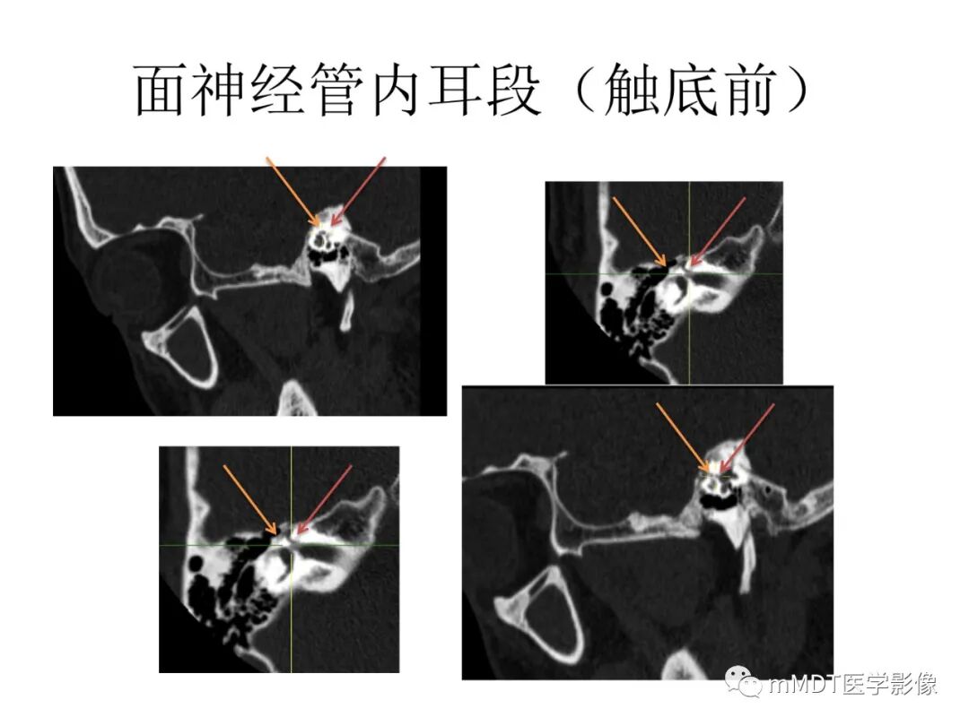 mmd在医学上什么意思触底四神共一门——穿行在内耳道的神经们_https://www.jmylbn.com_新闻资讯_第48张
