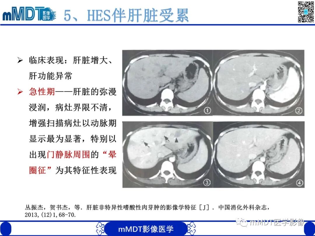 mmd在医学上什么意思嗜酸粒细胞增多综合征_https://www.jmylbn.com_新闻资讯_第25张