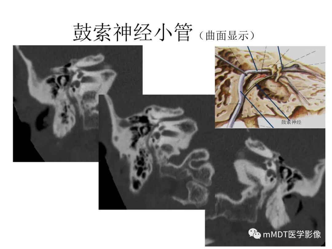 mmd在医学上什么意思触底四神共一门——穿行在内耳道的神经们_https://www.jmylbn.com_新闻资讯_第65张