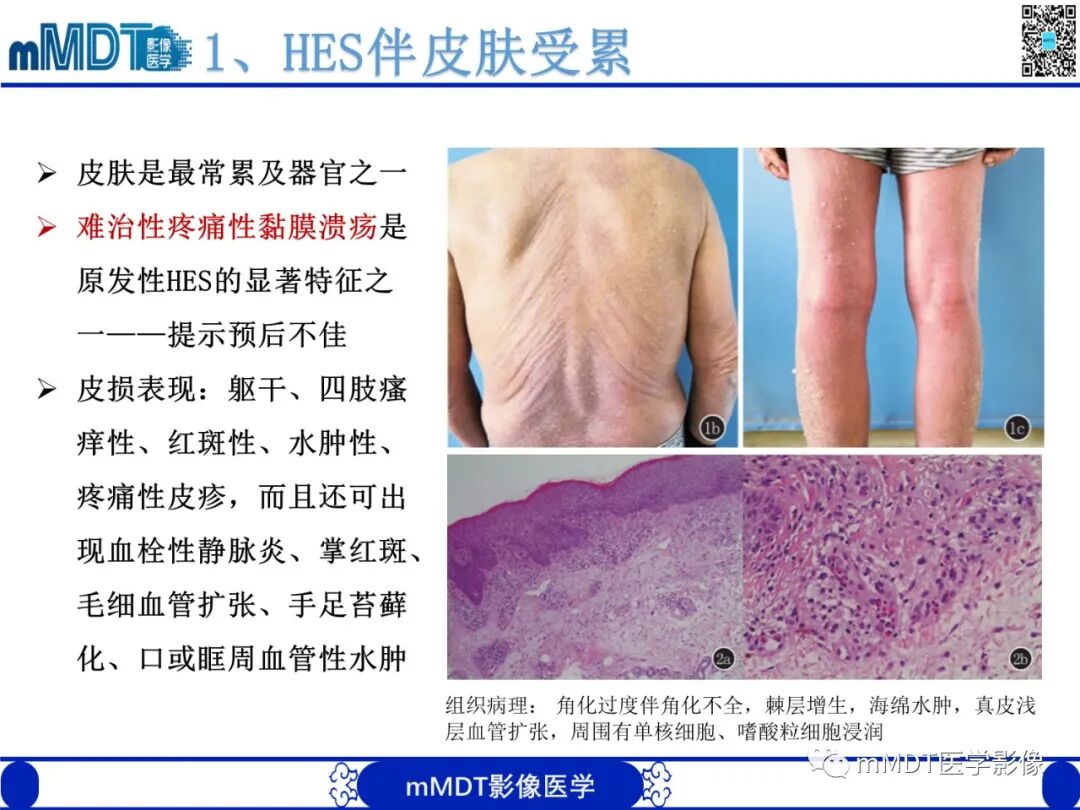 mmd在医学上什么意思嗜酸粒细胞增多综合征_https://www.jmylbn.com_新闻资讯_第17张