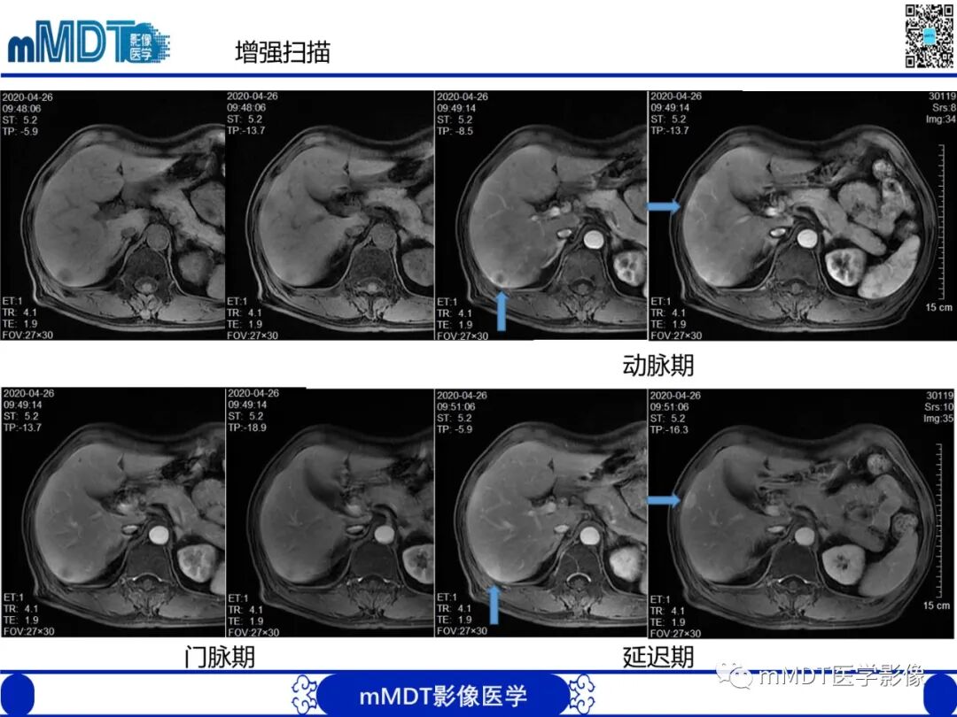 mmd在医学上什么意思嗜酸粒细胞增多综合征_https://www.jmylbn.com_新闻资讯_第9张