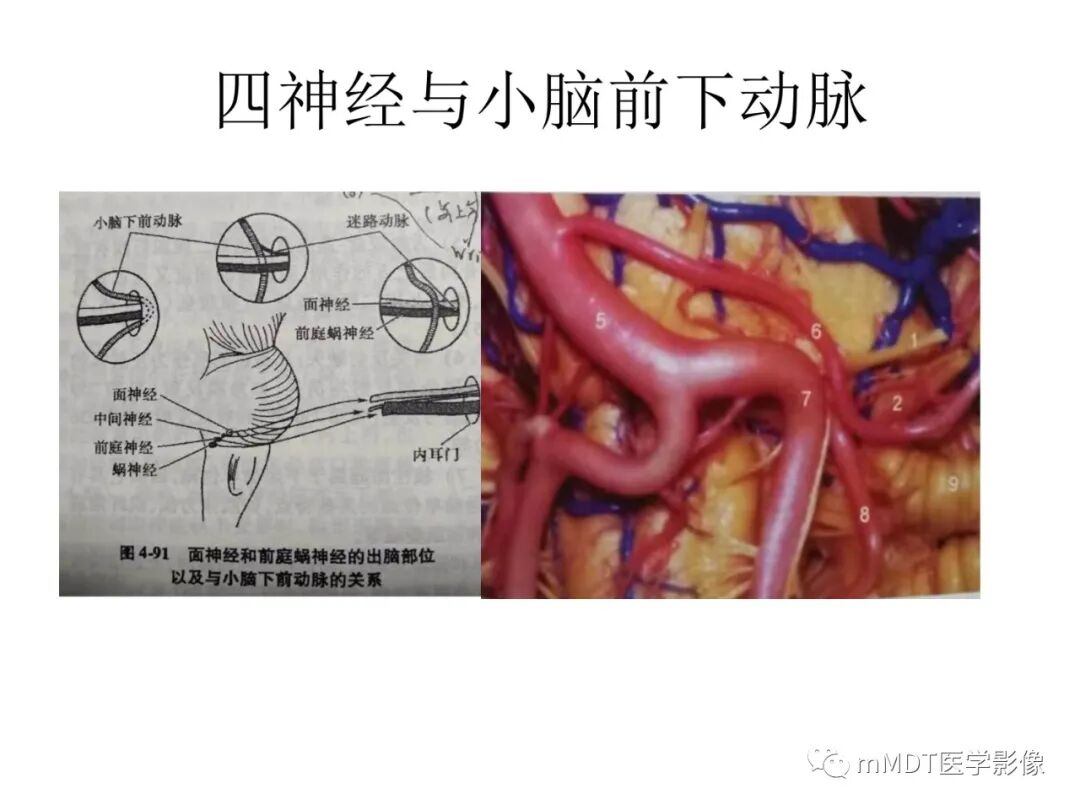 mmd在医学上什么意思触底四神共一门——穿行在内耳道的神经们_https://www.jmylbn.com_新闻资讯_第29张